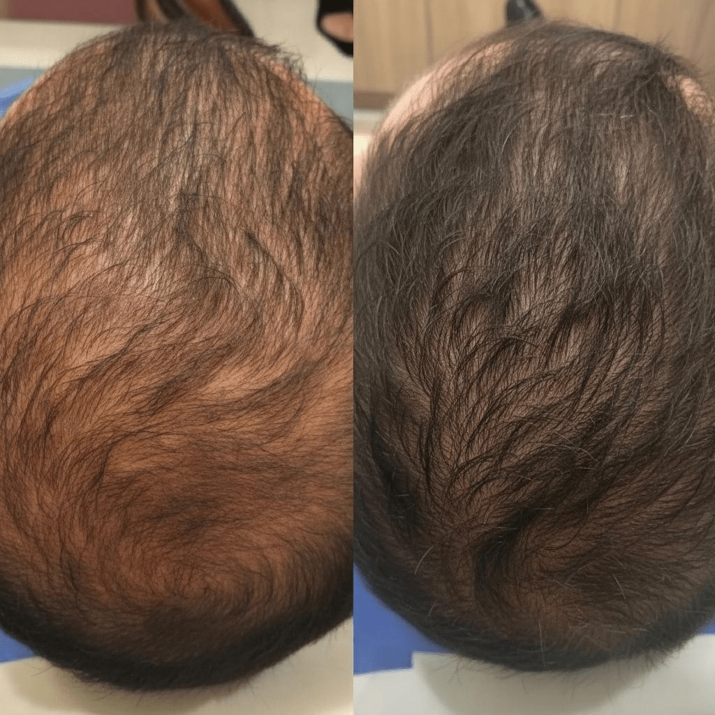 Suero Máximo de Densidad Capilar - HairMaximum